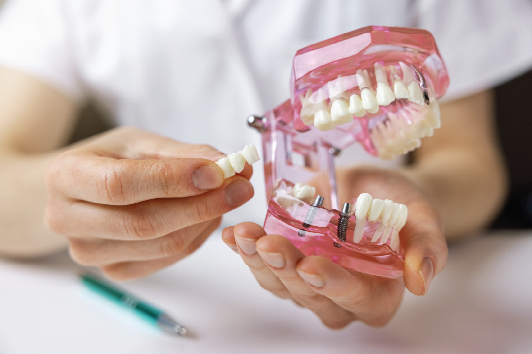 Implantes dentales