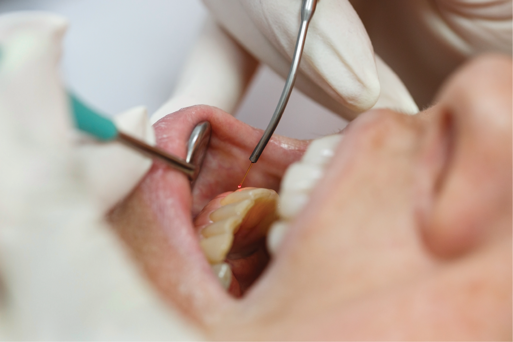 Odontología láser
